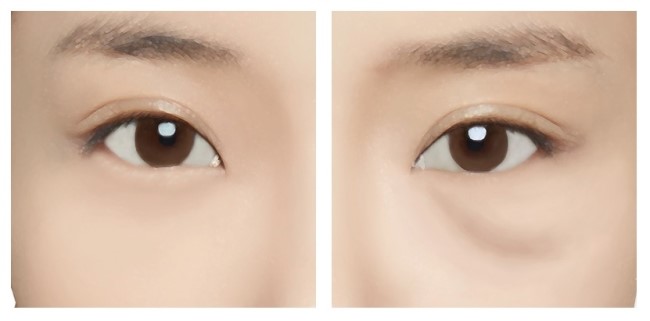 울퉁불퉁한 눈 밑, 피곤해 보이는 눈 밑 JW정원 눈밑지방재배치로 고민 해결! 관련 이미지 7
