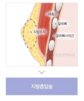 불룩한 가슴으로 고민이라면? 여성형유방(여유증) 성형도 역시 JW정원성형외과! 관련 이미지 4