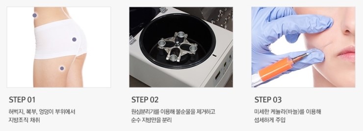 감출 수 없는 세월의 흔적, JW정원성형외과 손등지방이식으로 말끔하게! 관련 이미지 4