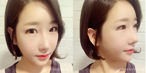 JW정원성형외과 눈+코성형으로 단아한 이미지 완성♡ 관련 이미지 3