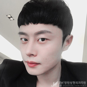 눈+코 성형으로 남성적인 이미지 UP 남자성형도 역시 JW정원성형외과! 관련 이미지 1