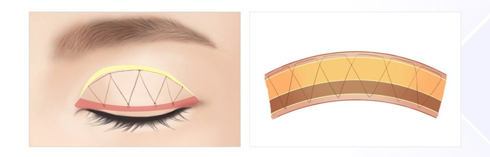 나에게 맞는 쌍꺼풀은? JW정원 쌍꺼풀수술 관련 이미지 3