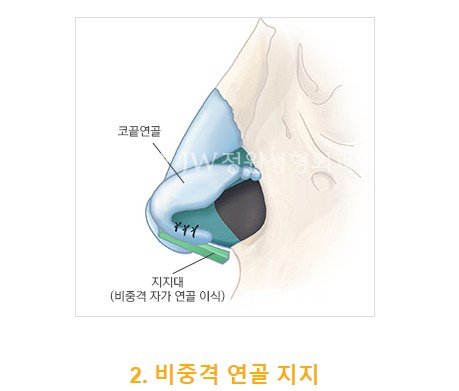 The Main Cause of a Long Nose in Aging! Making a Youthful Look with a Hooked Nose and Long Nose Surgery image 5