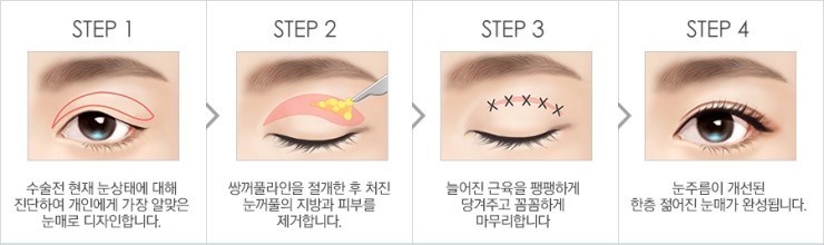 탄력있는 눈매로 확실하게 젊어지는 JW정원성형외과 상안검성형 관련 이미지 6