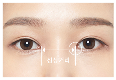 작고 답답한 눈에서 시원시원한 눈으로! JW정원성형외과 트임수술 관련 이미지 7