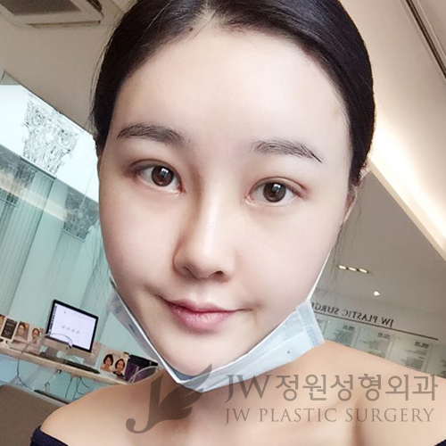 이마눈썹리프팅,눈매교정술,앞트임복원,코성형,지방이식 &rArr; JW정원성형외과에서! 관련 이미지 8