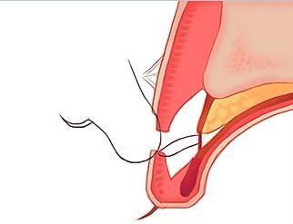 정확한 원인 판단과 시술로 완성하는 JW정원성형외과 눈재수술 관련 이미지 5