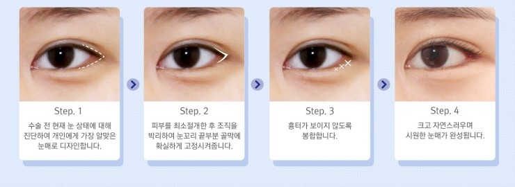 뒤트임 잘하는 병원! JW정원성형외과 뒷트임 성형 관련 이미지 4