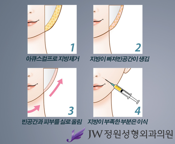 Triple Lifting That Delivers Three Effects in One Procedure, JW Garden Triple Lifting image 4