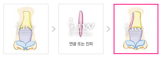 휘어진 코라인을 자연스럽게 바로 잡는 휜코성형 관련 이미지 1