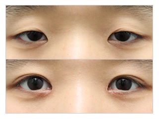 재수술이 아닌 마지막 수술! JW정원성형외과 눈재수술 관련 이미지 5