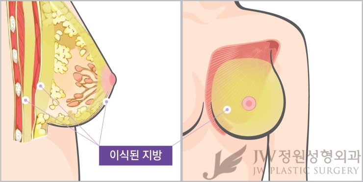 JW정원성형외과 가슴성형 √HD내시경 √하베스트젯2 √콤비네이션 가슴확대 관련 이미지 2