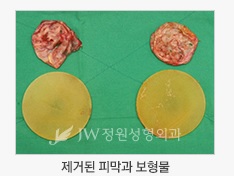 안전함과 아름다움을 동시에! JW정원성형외과 가슴재수술 관련 이미지 1