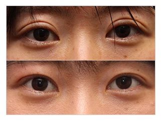재수술이 아닌 마지막 수술! JW정원성형외과 눈재수술 관련 이미지 4
