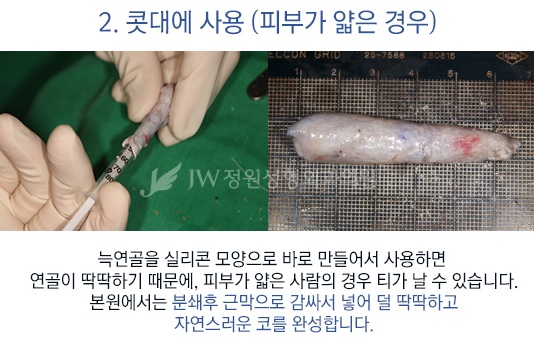 자연스러운 콧대! 견고한 코끝! JW정원성형외과 늑연골 코성형 관련 이미지 6