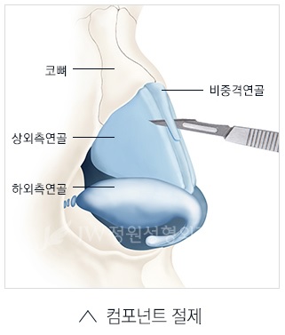 매부리코 교정? JW정원성형외과만의 핵심 노하우 공개! 관련 이미지 3