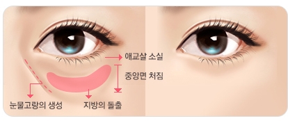 [JW정원성형외과]눈밑지방재배치 vs. 하안검수술, 선택기준은? 관련 이미지 1