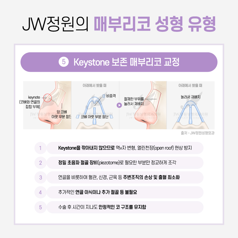 Hump Nose Surgery Cost: If You Want a Softer Line image 10