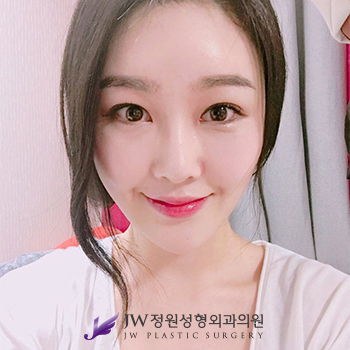 졸린 눈 No! 더 크고 더 또렷하게! JW정원성형외과 눈매교정 관련 이미지 4