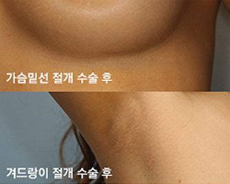 내트렐 510, JW정원성형외과에서 만나보세요! (앨러간) 관련 이미지 7
