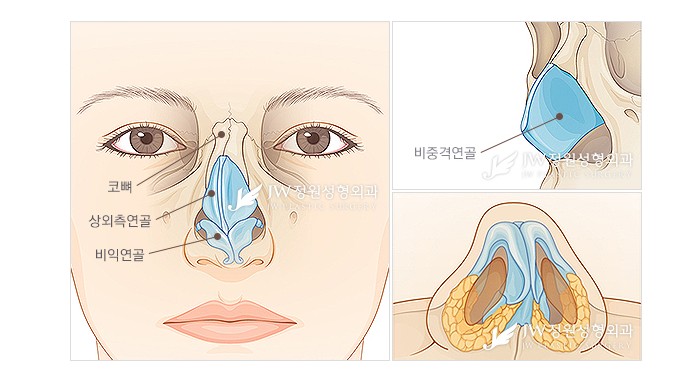 [JW정원성형외과] 코성형과 함께하는 비중격만곡증 및 비염수술 관련 이미지 2