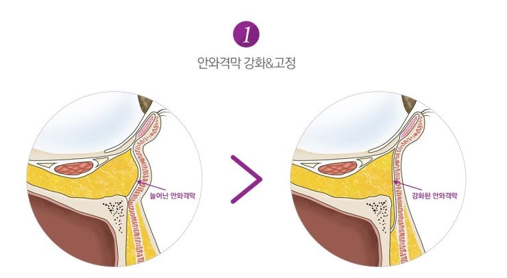 [JW정원성형외과] 눈밑지방재배치 핵심 기술력 관련 이미지 4