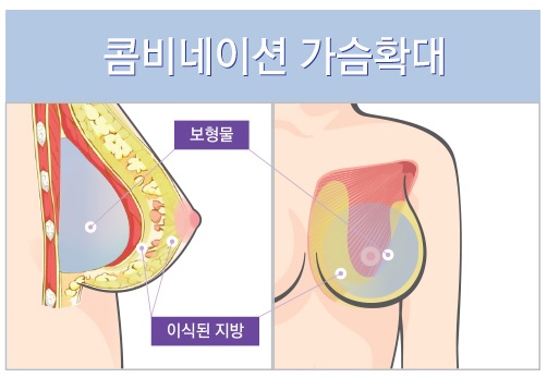 아찔한 가슴골, 콤비네이션 가슴확대수술로 자연스럽게 만들기 관련 이미지 3