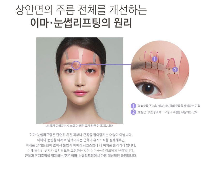 이마거상잘하는곳 눈꺼풀처짐을 개선하고 싶다면 【강남 JW정원성형외과】 관련 이미지 4