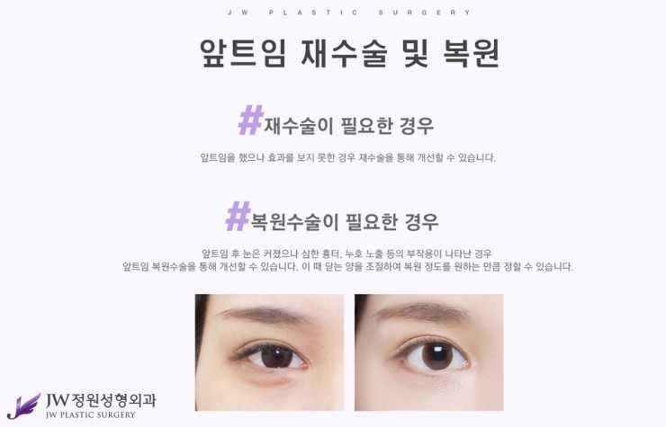 [JW정원성형외과] 앞뒷트임 재수술.복원 알아본다면? 트임복원 잘하는 곳에서! 관련 이미지 3