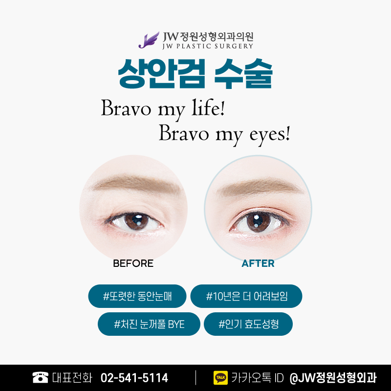 눈꺼풀처짐수술 되돌리는 세월 【강남 JW정원성형외과】 관련 이미지 5