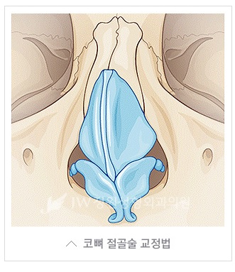 기능성과 심미성을 한번에! JW정원성형외과 휜코 교정 관련 이미지 3