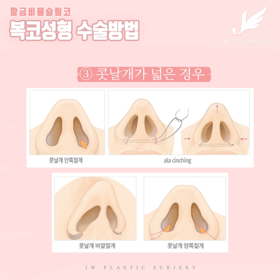 The Standard of Golden Ratio Bulbous Nose Surgery! JW Garden Plastic Surgery image 6