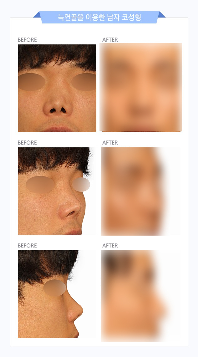 코재건수술, 자가늑연골로 견고한 콧대만들기 관련 이미지 9