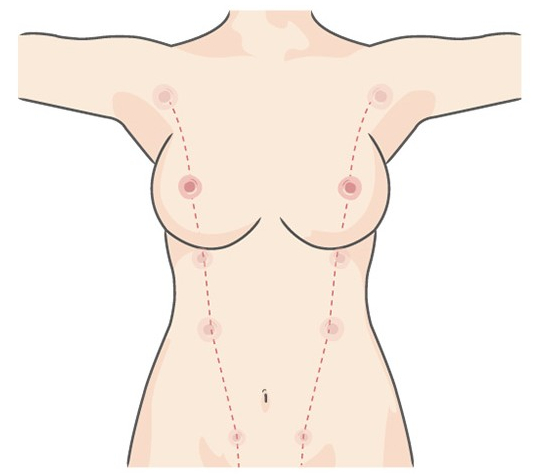겨드랑이 부유방제거, 가슴성형잘하는 병원으로 알아보기 관련 이미지 3