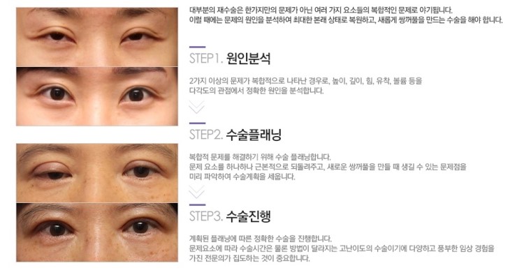 재수술이 아닌 마지막 수술! JW정원성형외과 눈재수술 관련 이미지 7
