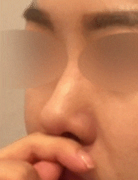 Best Place for Tip Rhinoplasty, See the Natural Results in a Tip Rhinoplasty Review image 3