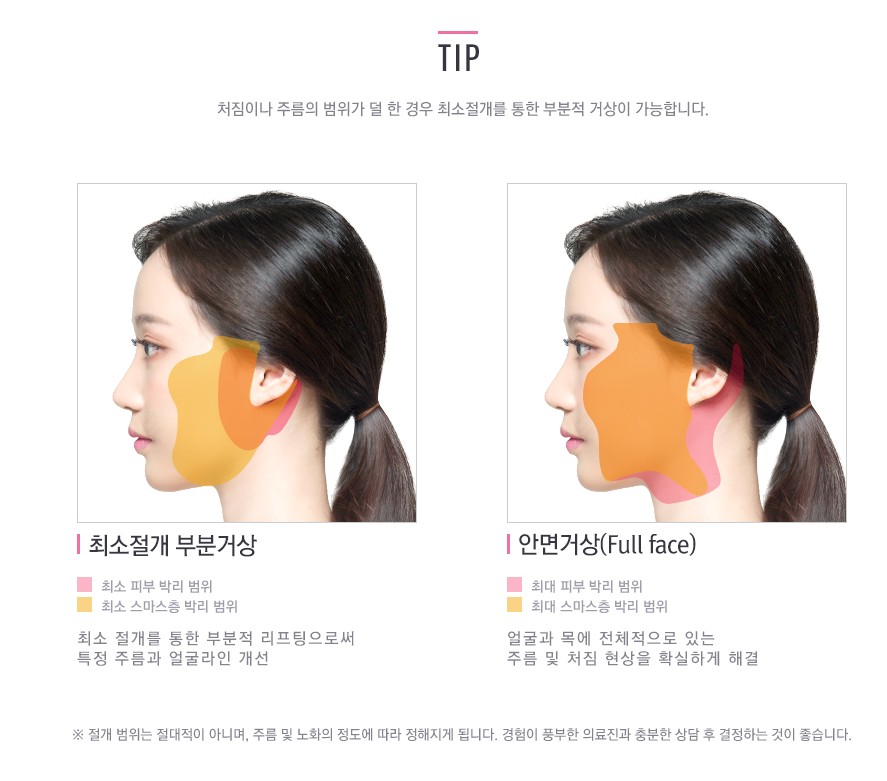 [JW정원 스마스리프팅] 꽃중년 미모의 완성, 스마스리프팅으로 관련 이미지 6