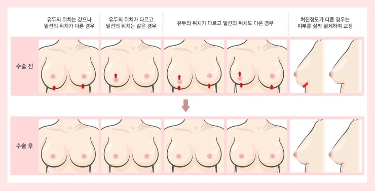 [JW정원성형외과] 처진가슴! 거상없이 확대수술만으로 해결! JW정원 처짐교정확대술 관련 이미지 8