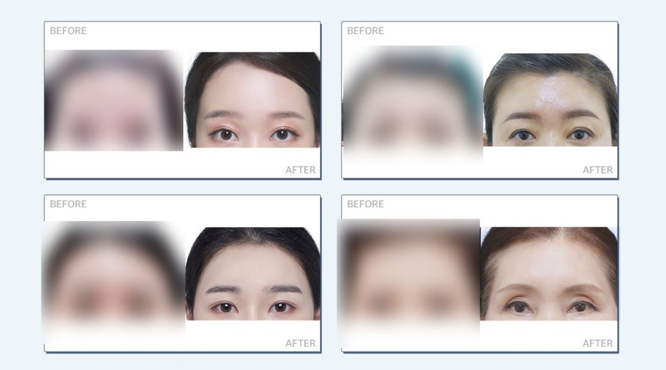 이마거상술, 내시경이마거상으로 안전성과 오랜 지속효과까지 관련 이미지 2