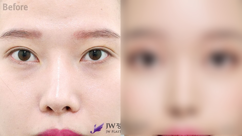 Crooked Nose Surgery: Correcting the Tip and Nostril Asymmetry at the Same Time image 1