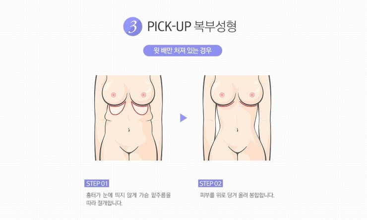 처지고 늘어진 뱃살 탈출! 완벽 S라인으로 변신 JW정원 복부성형 관련 이미지 5
