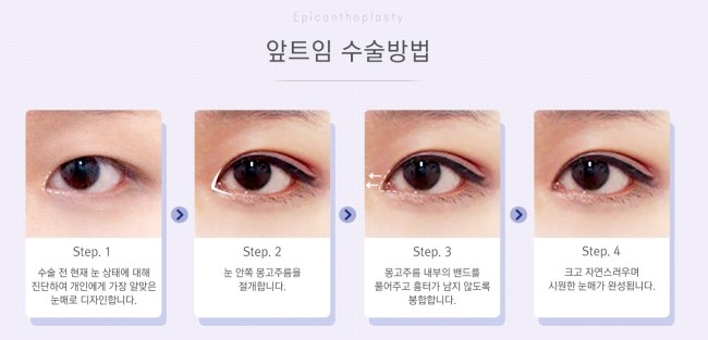 작고 답답한 눈매를 크고 시원스럽게! JW정원성형외과 360&deg; 멀티트임 관련 이미지 2