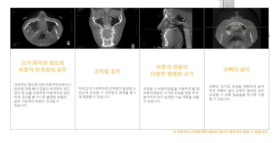 밋밋한 얼굴을 입체감 있는 얼굴로, 낮은코성형후기로 알아봐요 관련 이미지 5