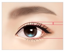 눈재수술! 병원선택부터 신중하게! JW정원성형외과 쌍꺼풀 재수술 관련 이미지 3