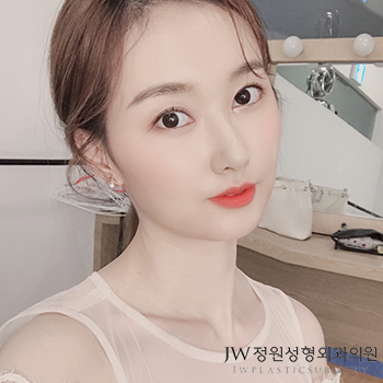 코재건수술, 자가늑연골로 견고한 콧대만들기 관련 이미지 1