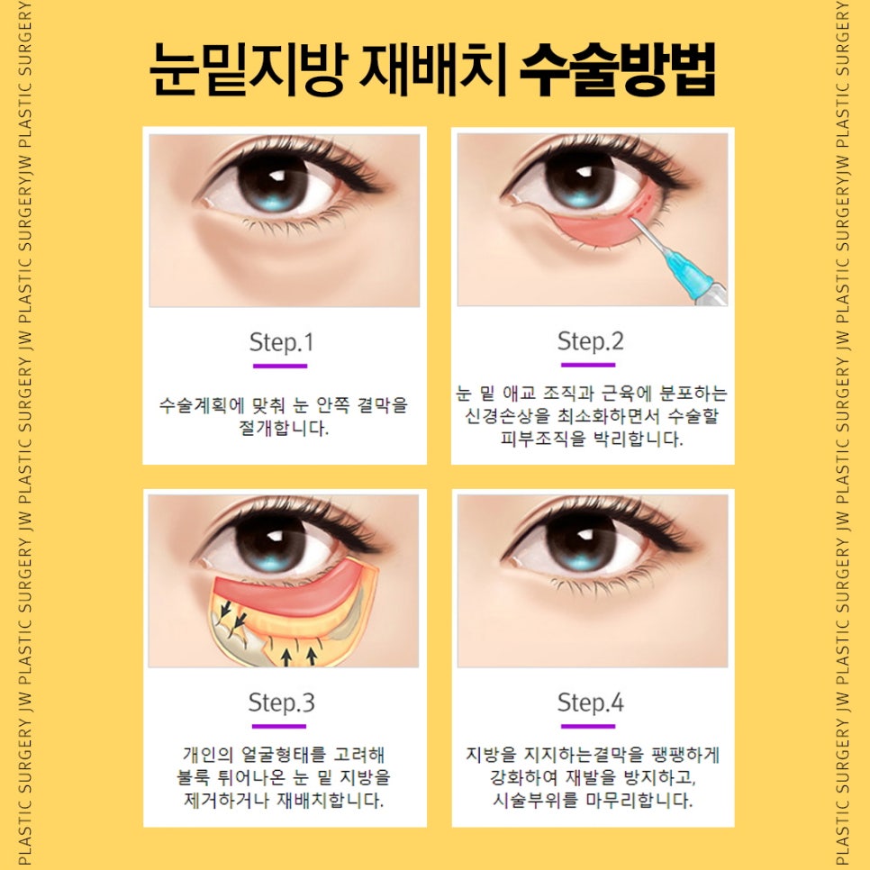다크서클, 눈밑지방재배치로 탄력있는 동안 눈매 완성 관련 이미지 4