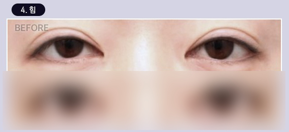 Double Eyelid Line Revision Surgery: Finding a Clinic That Is Good at Eye Revision Surgery image 5