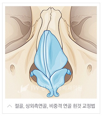 기능성과 심미성을 한번에! JW정원성형외과 휜코 교정 관련 이미지 4