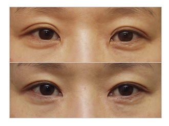 재수술이 아닌 마지막 수술! JW정원성형외과 눈재수술 관련 이미지 2