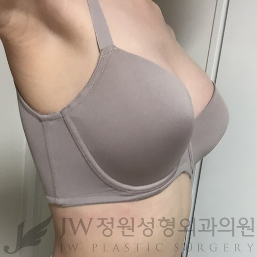 [JW정원성형외과]더 자연스러운 가슴성형, 콤비네이션가슴확대♡ 관련 이미지 9
